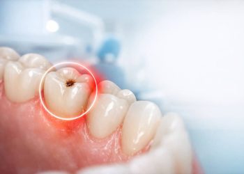 Răng Số 5 Bị Sâu: Triệu Chứng, Cách Chữa Hiệu Quả Nhất