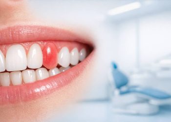 Nướu Răng Bị Sưng Nhưng Không Đau: Nguyên Nhân & Cách Xử Lý